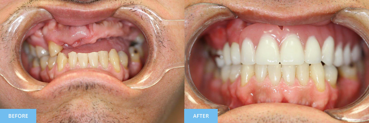 Before and After Gallery | Somerville Comprehensive Dental Care